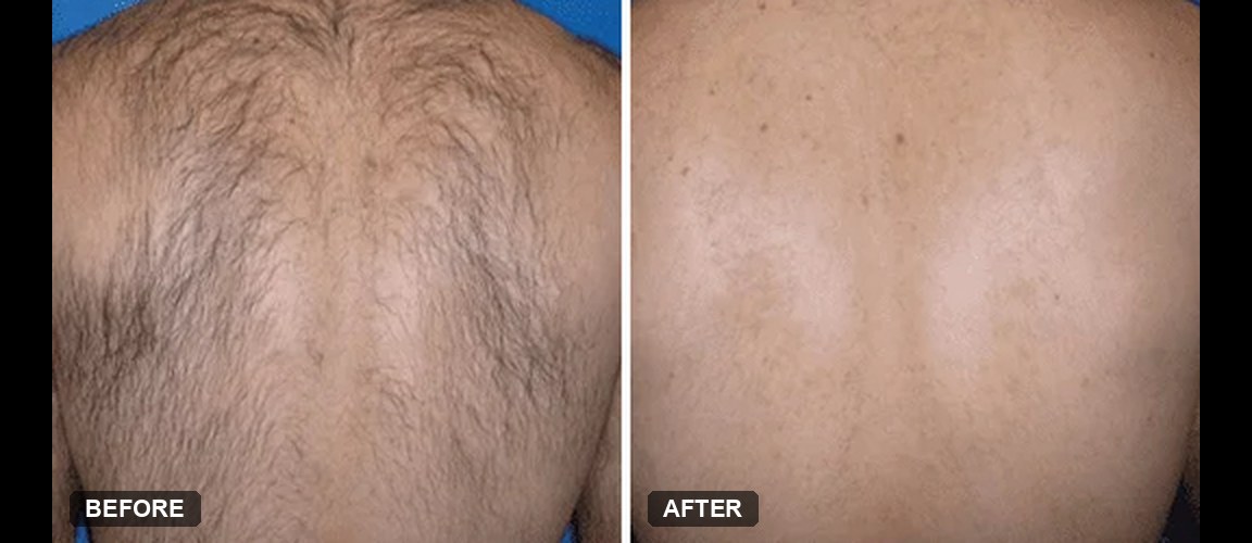 Soprano ICE laser hair removal before and after, back