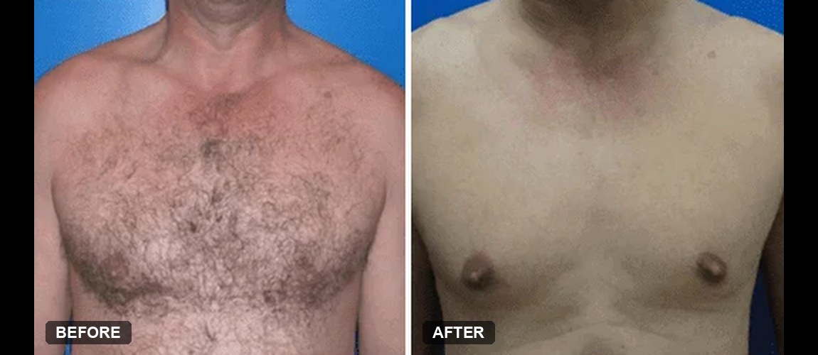 Soprano ICE laser hair removal before and after, chest