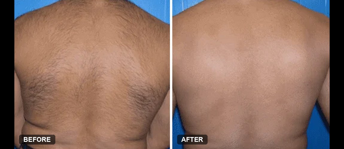 Soprano ICE laser hair removal before and after, back